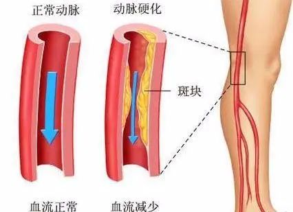 介入治療開通血管， 動(dòng)脈閉塞暢通無憂！